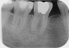 Root canal retreatment of open apex - Case 1