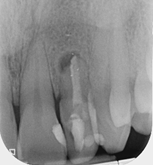 Root canal retreatment of open apex - Case 2