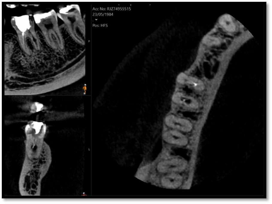 Root canal retreatment of open apex - Case 3