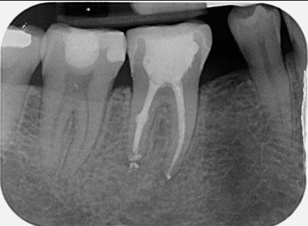 Root canal retreatment of open apex - Case 4
