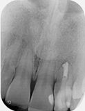Root canal retreatment of open apex - Case 5